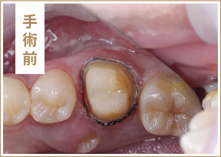 牙周治療案例圖片1